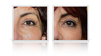 Blepharoplasty