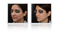 Primary open tip reduction rhinoplasty combined with chin reduction