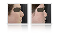 Rhinoplasty