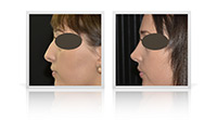 Primary open tip rhinoplasty