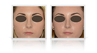 Rhinoplasty
