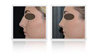 Rhinoplasty