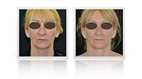 Facelift, neck lift, fat transfer, Blepharoplasty