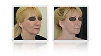 Facelift, neck lift, fat transfer, Blepharoplasty