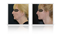 Facelift, neck lift, fat transfer, Blepharoplasty