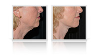 Neck lift
