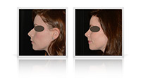 Rhinoplasty