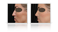 Rhinoplasty Open Tip, Rhinoplasty Primary, Rhinoplasty Reduction