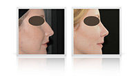 Rhinoplasty