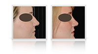 Open Tip Rhinoplasty, Reduction Rhinoplasty, Primary Rhinoplasty