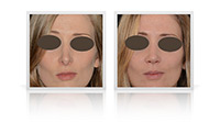 Rhinoplasty