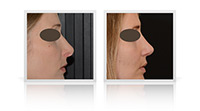 Rhinoplasty