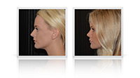 Rhinoplasty / Nose reshaping