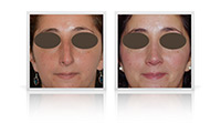 Rhinoplasty / Nose reshaping