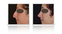 Rhinoplasty / Nose reshaping
