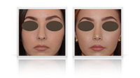 Rhinoplasty / Nose reshaping