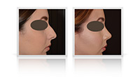 Rhinoplasty / Nose reshaping