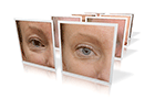 blepharoplasty