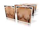 breast surgery
