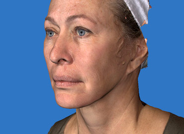 Volumetric Facial Rejuvenation