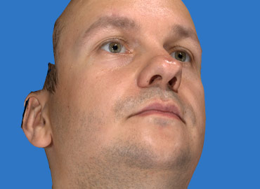 Nasal Tip Rhinoplasty Simulation