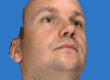 Nasal Tip Rhinoplasty Simulation