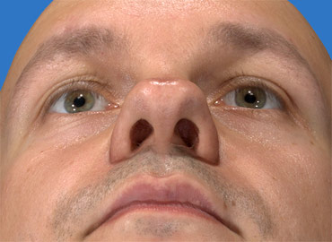 Alar Base Rhinoplasty Simulation