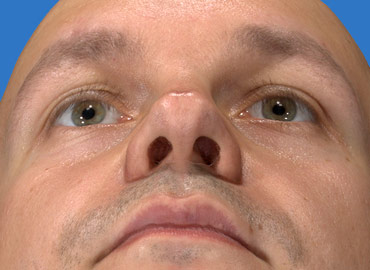 Alar Base Rhinoplasty Simulation