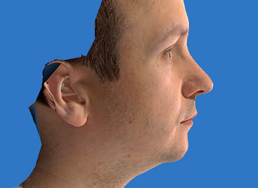 Nasal Length Rhinoplasty Simulation