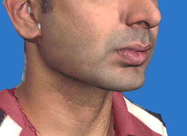 Facial Sculpting 3d Simualtion